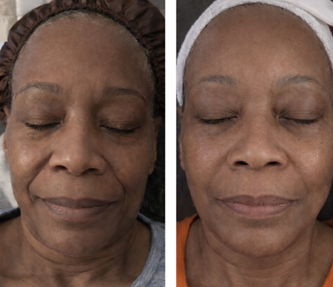 Deep Collagen Peptide Lifting Ampoule